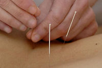 L'acupuncture est un art millénaire qui vise à rétablir l'harmonie entre le yin et le yang ©Sipa