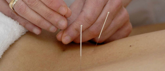 L'acupuncture est un art millenaire qui vise a retablir l'harmonie entre le yin et le yang (C)Sipa