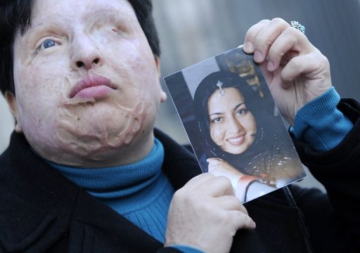 La jeune Iranienne Ameneh Bahrami, aveuglee et defiguree a l'acide, a pardonne a son agresseur et renonce a l'application de la loi du talion selon laquelle ce dernier aurait du etre aveugle dimanche, a annonce le site de la television d'Etat.