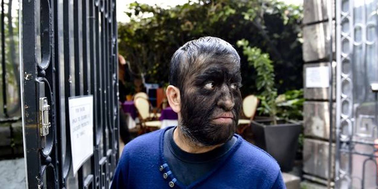 Mexique : l'homme loup-garou assume son visage recouvert de poils