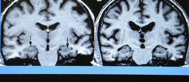 IRM d'un cerveau (illustration).