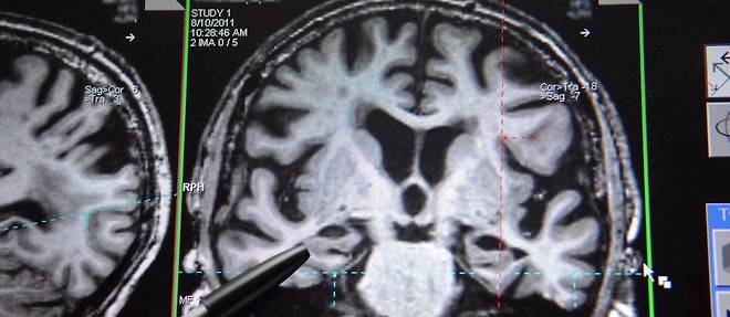 IRM montrant un cerveau dont les hippocampes sont atteints par la maladie d'Alzheimer realisee a l'Institut du cerveau et de la moelle epiniere a Paris
