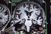 IRM montrant un cerveau dont les hippocampes sont atteints par la maladie d’Alzheimer réalisée à l'Institut du cerveau et de la moelle épinière à Paris ©DURAND FLORENCE/SIPA