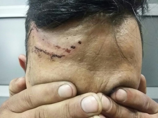 Un migrants montre ses blessures infligees par la police des frontieres hongroise pres de la frontiere serbo-hongroise, le 8 mars a Belgrade