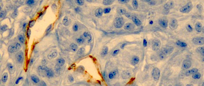 Coupe d'une tumeur observee avec un microscope optique. Les deux formes blanches au pourtour marron sont des vaisseaux sanguins. A l'interieur, des nanoparticules d'or s'accumulent contre leur paroi. 
 
 