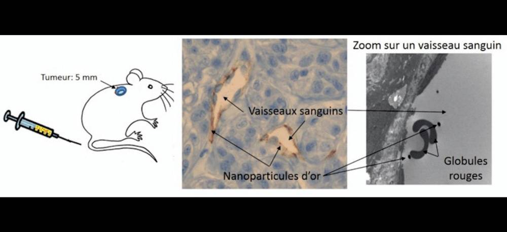 Les nanoparticules d’or sont injectées à une souris porteuse d’une tumeur. Cinq heures plus tard, des coupes de la tumeur sont observées avec un microscope optique (photo du milieu). On constate que les nanoparticules d’or « décorent » le bord des vaisseaux sanguins. La photo de droite est un zoom sur un vaisseau sanguin, en microscopie électronique. On distingue deux globules rouges et des nanoparticules d’or à l’intérieur du vaisseau. Les nanoparticules vont s’accumuler dans la tumeur et pourront ensuite être éclairées pour chauffer et détruire la tumeur. 
 
 © Mariana Varna-Pannerec ESPCI