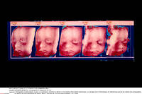  Portrait en 3D d'un fœtus grâce à l'échographie morphologique couleur ou Cybergram.  ©A.T.L/TOMTEK/VON GOMBERGH/SIPA