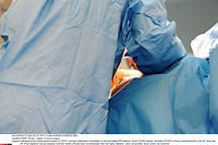  Selon une étude, la pose d'une prothèse ne diminue pas toujours la douleur des patients.  ©DURAND FLORENCE/SIPA