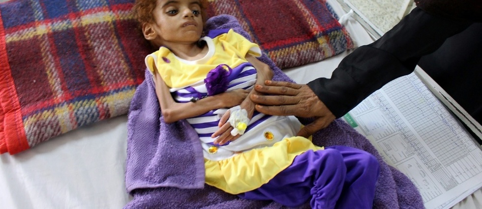 Au Yemen, le desespoir des medecins face aux enfants affames