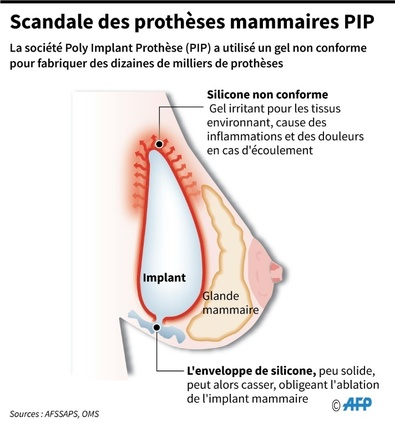 Protheses mammaires PIP : un nouveau proces en France pour le certificateur allemand TUV