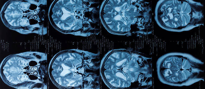 Scanner d'un cerveau humain (illustration).