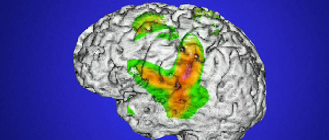 Image tridimensionnelle du cerveau calculee a partir d'un examen anatomique d'Imagerie par resonance magnetique (IRM) et d'un examen fonctionnel de magneto-encephalographie (ou MEG). L'examen fonctionnel de magneto-encephalographie (couleur) montre, a un instant donne, l'activite du cerveau pendant une tache de repetition de mots. Il a ete demande au sujet de repeter plusieurs fois les mots suivants : << mais, ou, et, donc, or, ni, car >>. Universite Rennes-1.