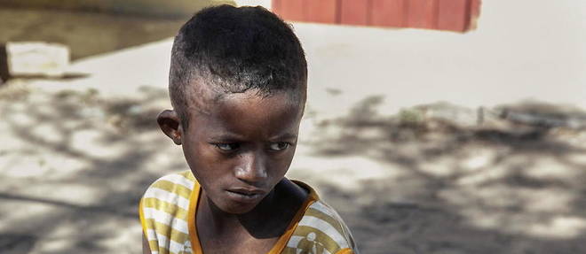 Un enfant de 9 ans ne pesant que 20 kilos et montrant des signes de malnutrition, a Befeno, Madagascar, le 2 septembre 2021. Photo d'illustration.
