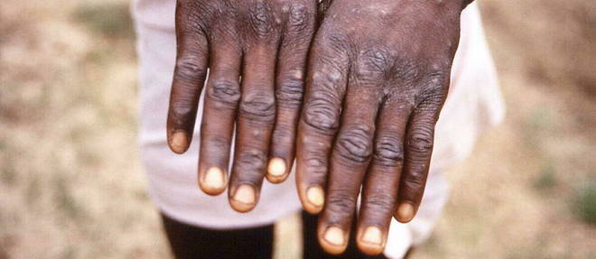 La variole du singe est presente dans 11 pays d'Afrique, mais plus d'une centaine de cas ont ete detectes en dehors de ce continent (photo d'illustration).
