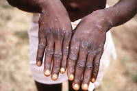 La variole du singe est présente dans 11 pays d'Afrique, mais plus d'une centaine de cas ont été détectés en dehors de ce continent (photo d'illustration).
