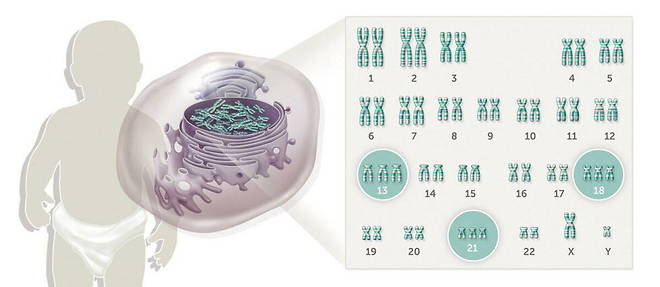 Illustration des differentes trisomies mises en evidence sur une carte genetique. Chaque personne possede 22 paires de chromosomes et deux chromosomes sexuels uniques.  La trisomie concerne les chromosomes 13, 18 et 21, qui ont trois chromosomes identiques au lieu d'une paire.
