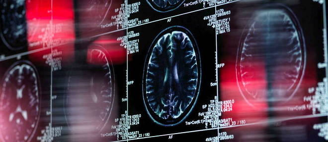 Imagerie par resonance magnetique (IRM) d'un cerveau humain sur un ecran.
