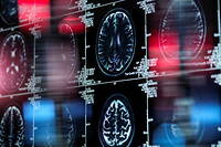 Imagerie par résonance magnétique (IRM) d'un cerveau humain sur un écran.
