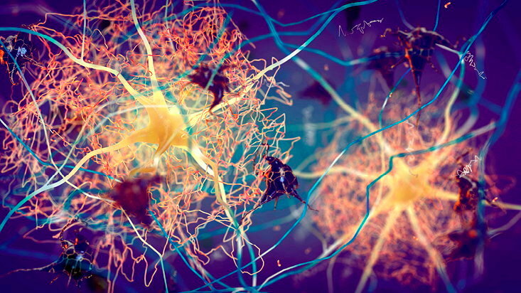Les plaques amyloides s'accumulent entre les neurones.