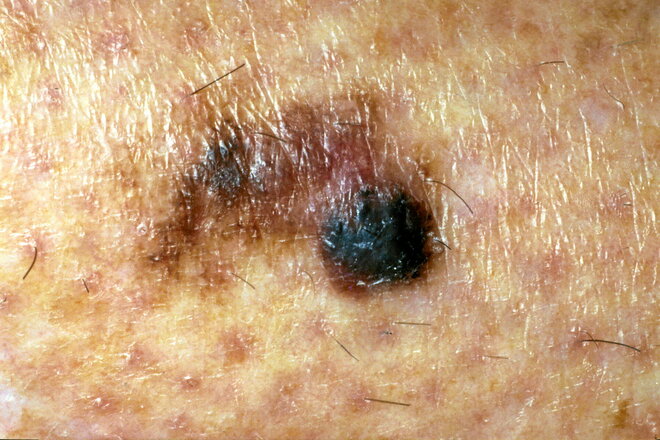 Cancer De La Peau Mortel www.lepoint.fr