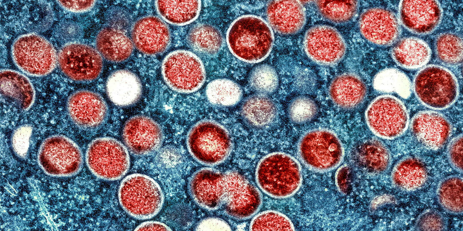 Qu'est-ce que l'« Alaskapox », une forme de variole qui vient de faire son premier mort aux États-Unis ?