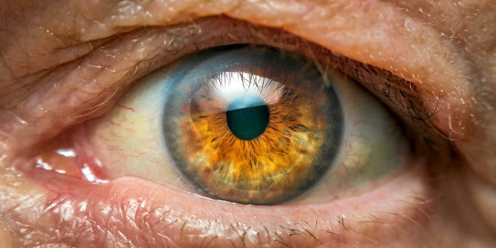 Everything you need to know about cataract surgery